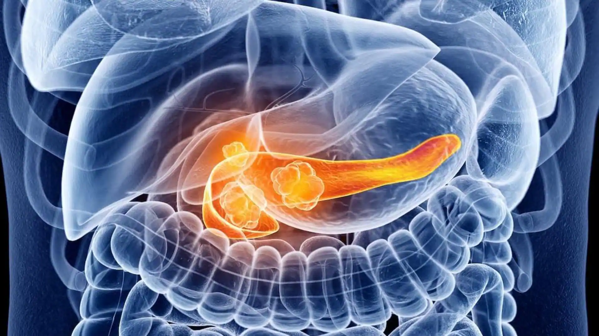 Game-Changing Pill Offers New Hope, Doubles Pancreatic Cancer Survival